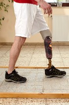 Prosthetic Leg - Charitable Donations